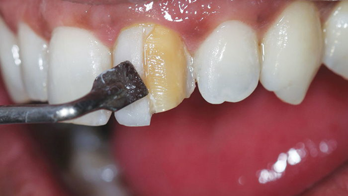 کامپوزیت یک ماده سفید رنگ است که روی سطح خارجی دندان قرار می گیرد