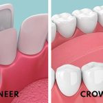 تفاوت ظاهری کامپوزیت دندان (veneer) را با روکش دندان (crown)