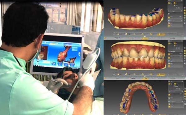  کاشت ایمپلنت دندان به شیوه دیجیتال