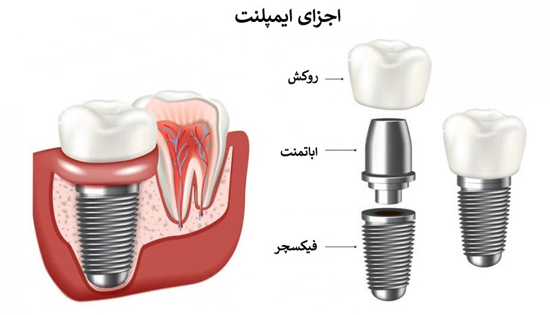 اجزای ایمپلنت دندان