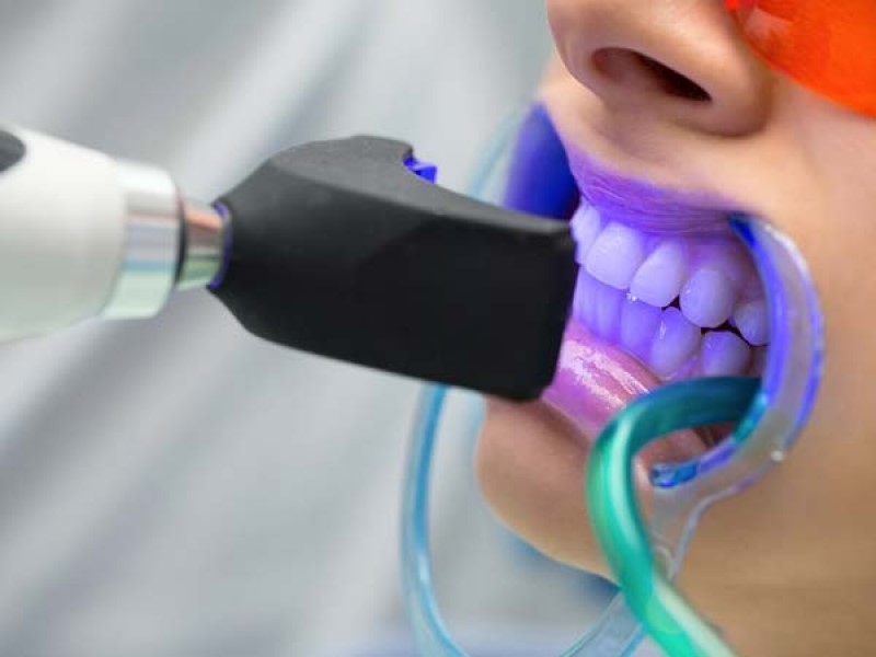انجام بلیچینگ در کلینیک دندانپزشکی