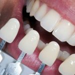 آشنایی با قیمت کامپوزیت دندان و عوامل موثر بر آن