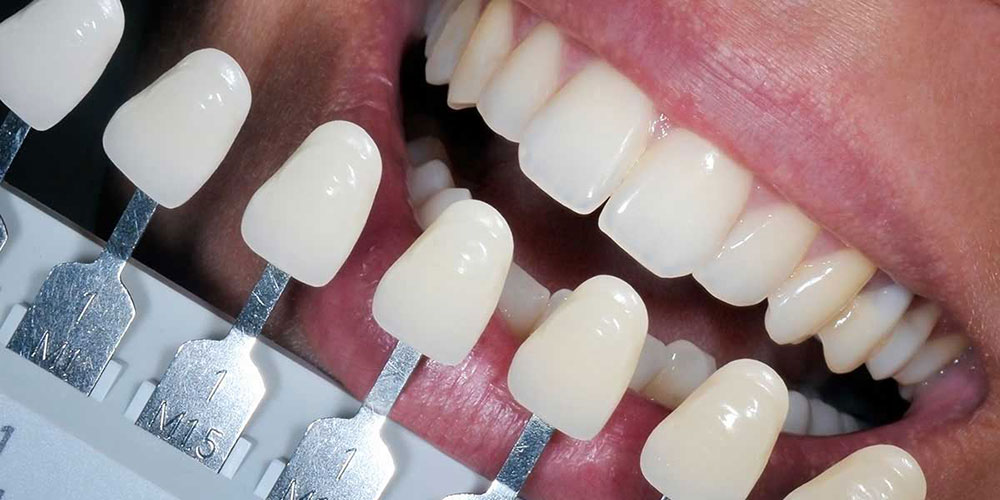 آشنایی با قیمت کامپوزیت دندان و عوامل موثر بر آن