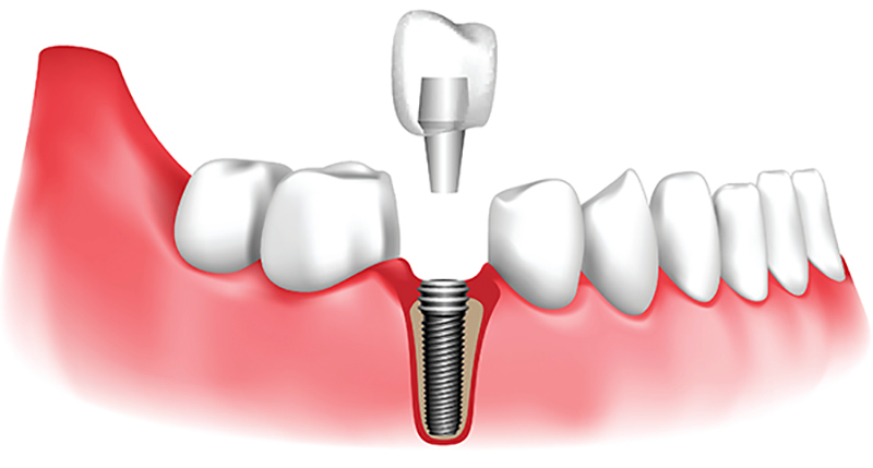 ایمپلنت دندان چیست؟