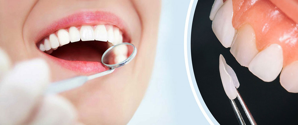 بهترین نوع لمینت دندان کدام می باشد؟