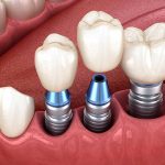 نکاتی در مورد ماندگاری ایمپلنت دندان