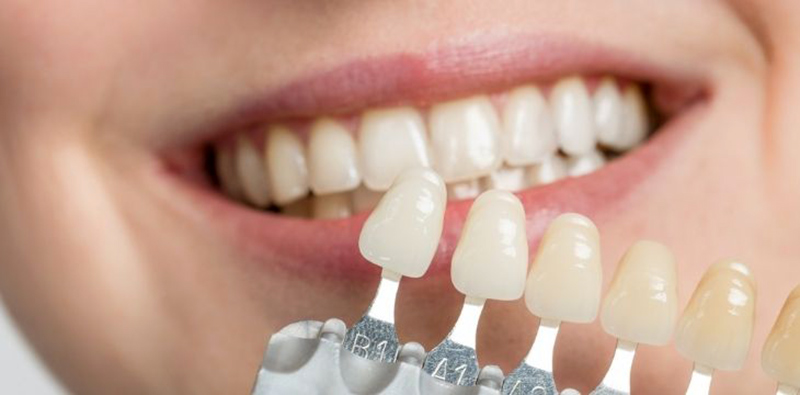 تفاوت روکش و کامپوزیت دندان