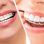 ارتودنسی دندان ثابت بهتر است یا متحرک؟