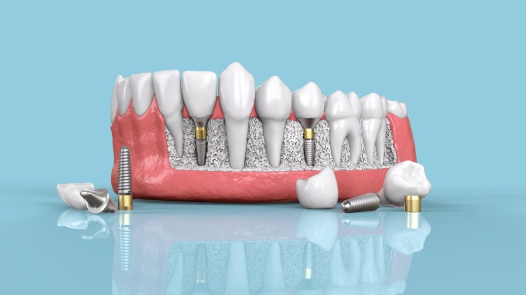 ایمپلنت نئو دنت چه ویژگی‌هایی دارد؟